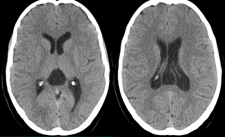 Cavum septum pellucidum, cavum vergae, and cavum veli interpositi ...