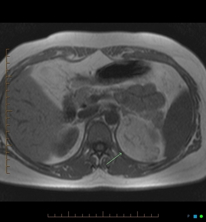 Extra-renal angiomyolipoma | Radiology Case | Radiopaedia.org