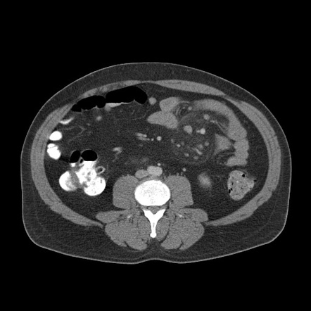 Mesenteric panniculitis | Radiology Case | Radiopaedia.org