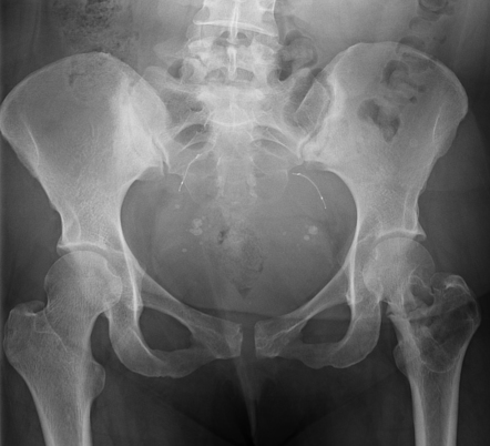 Intraosseous schwannoma | Radiology Case | Radiopaedia.org