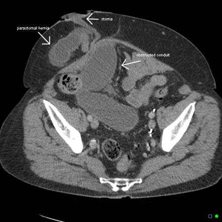 Lung Hernia Radiology Reference Article Radiopaedia Org Hot Sex Picture