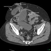 Parastomal Hernia Radiology Reference Article Radiopaedia Org