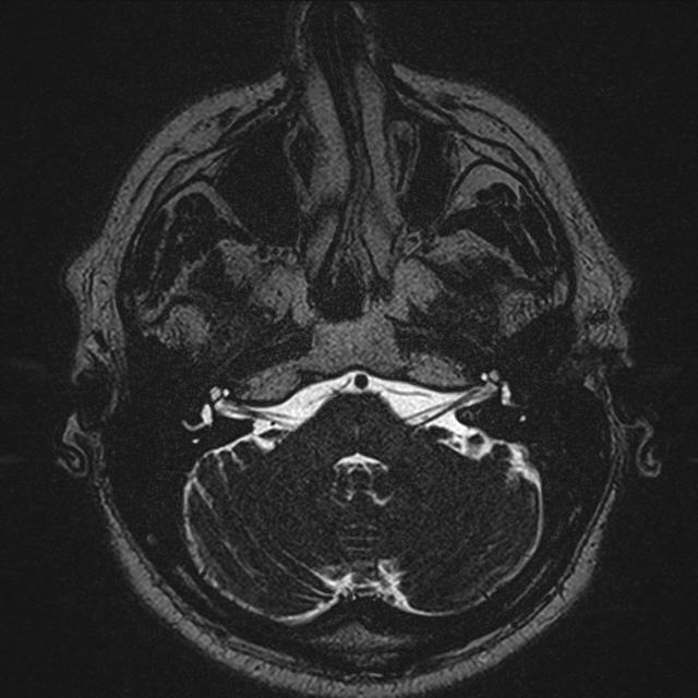 Facial and vestibulocochlear nerves - normal MRI appearance | Image ...