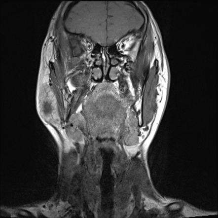 Parotid pleomorphic adenoma: myxoid type | Image | Radiopaedia.org