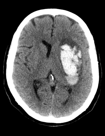 Lobar intraparenchymal hemorrhage | Radiology Case | Radiopaedia.org