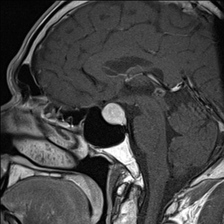 Pituitary macroadenoma | Radiology Case | Radiopaedia.org