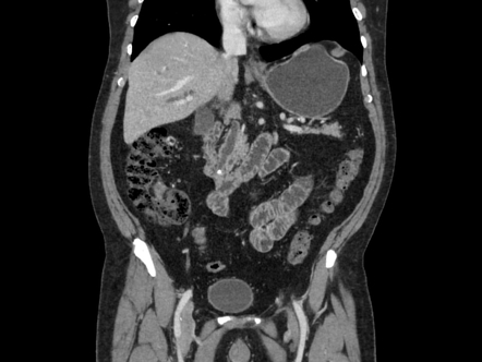 Ampulla of Vater stone and pancreas divisum | Image | Radiopaedia.org