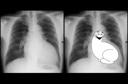 Shmoo sign | Radiology Reference Article | Radiopaedia.org