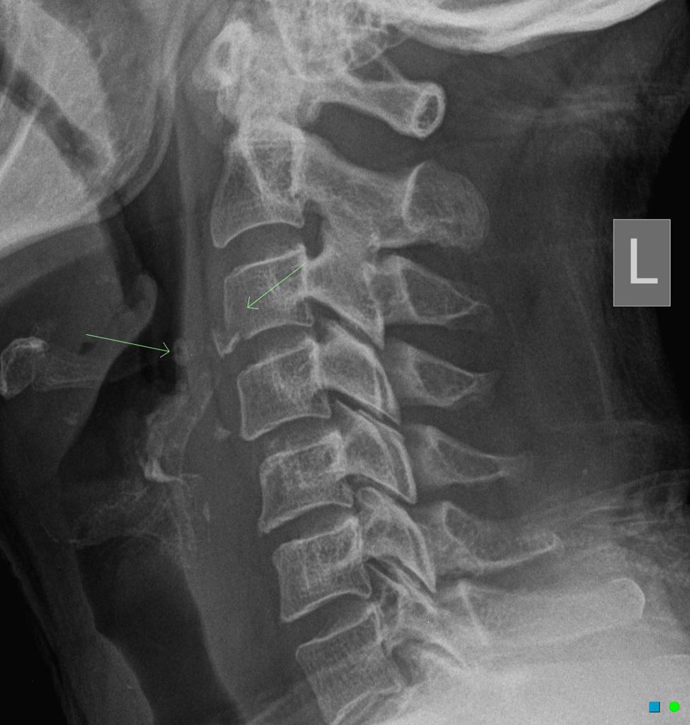 Extension Teardrop Fracture Cervical Spine Radiology Case Radiopaedia Org