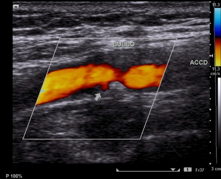 carotid doppler radiology