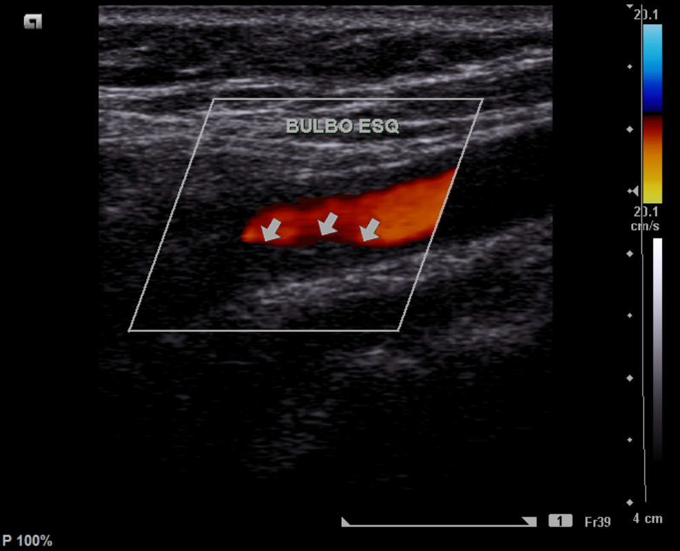 ulcerated-plaque-in-the-carotid-artery-image-radiopaedia