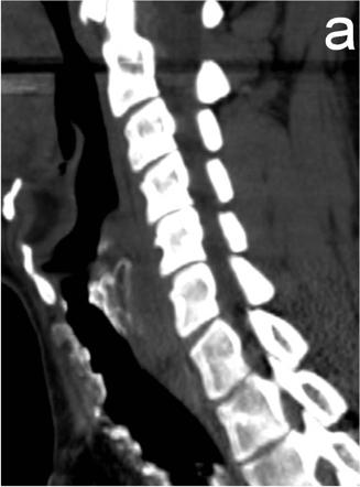 Tracheopathia osteochondroplastica | Image | Radiopaedia.org