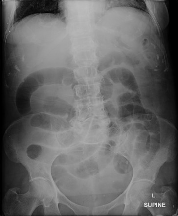 Small bowel obstruction from incarcerated direct inguinal hernia ...