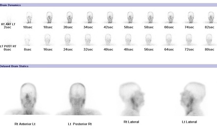 Hot nose sign | Radiology Reference Article | Radiopaedia.org