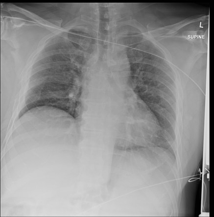 Scapular fracture | Radiology Case | Radiopaedia.org