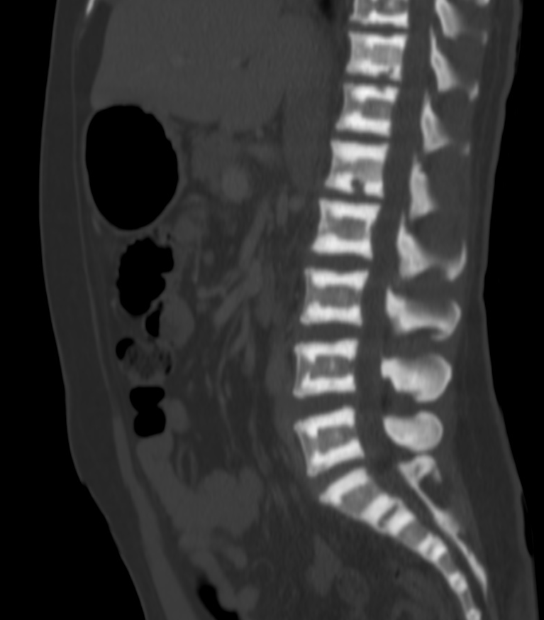 Sandwich vertebral body - osteopetrosis | Image | Radiopaedia.org