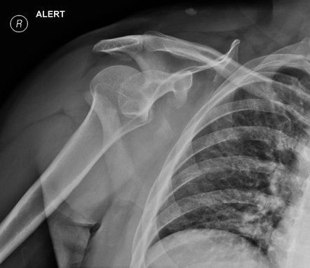 Scapular fracture | Radiology Case | Radiopaedia.org