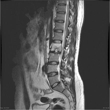 Spondylodiscitis | Radiology Reference Article | Radiopaedia.org