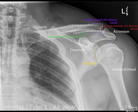 Rockwood classification of acromioclavicular joint injury (annotated ...