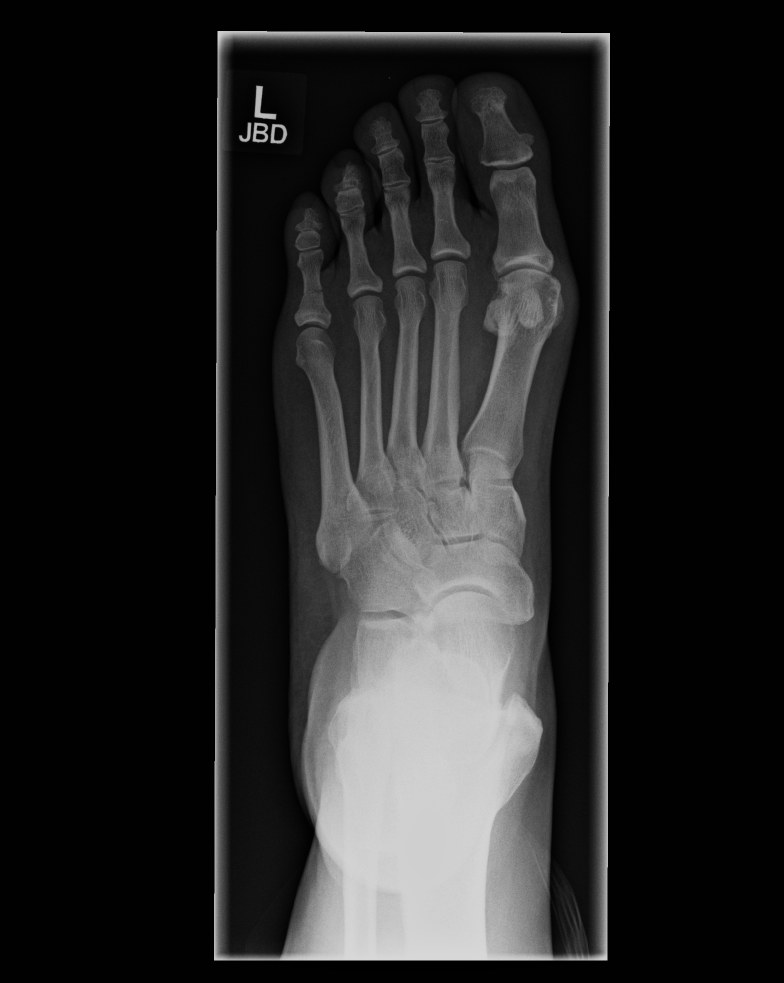 Fifth Proximal Phalanx Fracture Image 