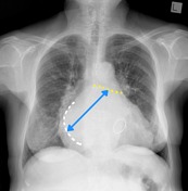 Left atrial enlargement | Radiology Reference Article | Radiopaedia.org