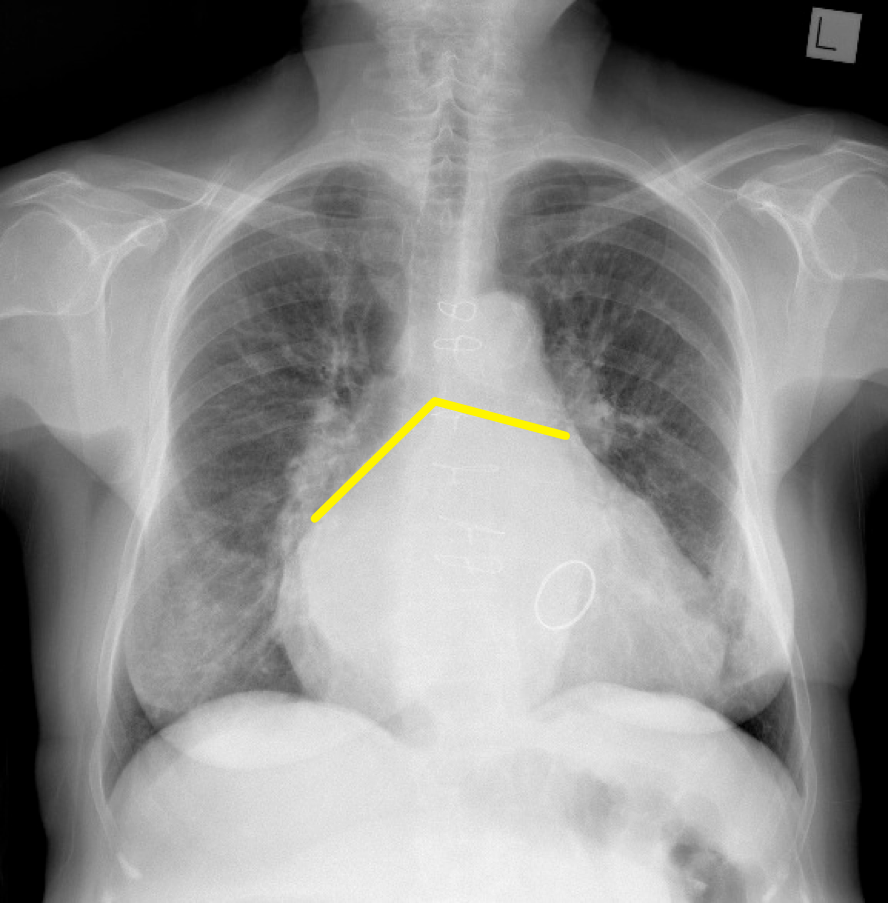 left-atrial-enlargement-image-radiopaedia