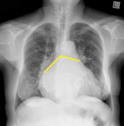 Left atrial enlargement | Radiology Reference Article | Radiopaedia.org