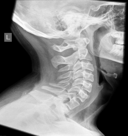 Arcuate foramen | Radiology Reference Article | Radiopaedia.org