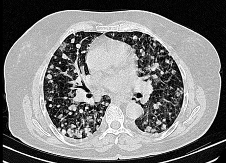 Ct Metastatic Lung Cancer