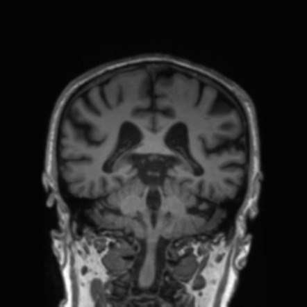 Progressive Supranuclear Palsy (PSP) | Image | Radiopaedia.org