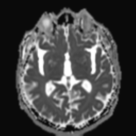 Progressive Supranuclear Palsy (PSP) | Image | Radiopaedia.org