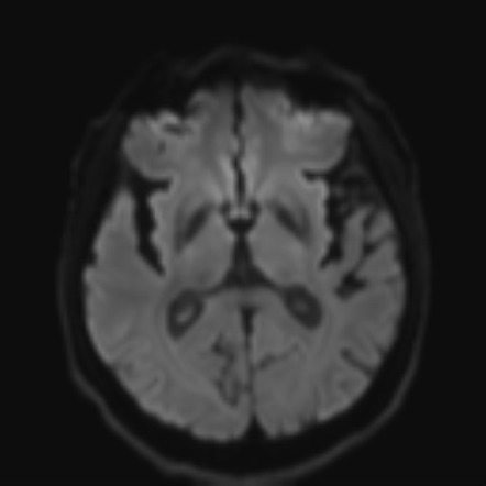 Progressive Supranuclear Palsy (PSP) | Image | Radiopaedia.org