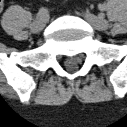 Conjoined S1 and S2 nerve roots | Radiology Case | Radiopaedia.org