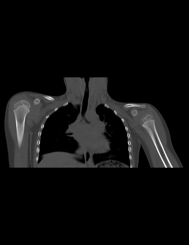 Erb palsy | Image | Radiopaedia.org