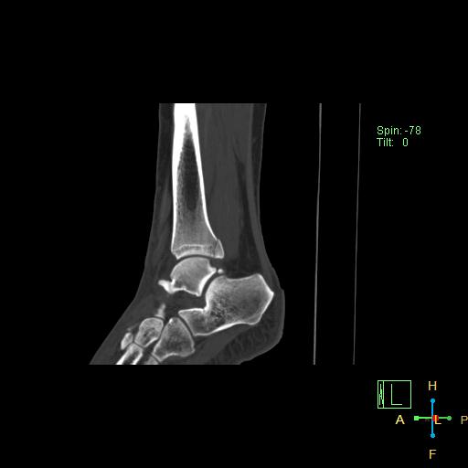 Ankle Fracture - Weber C | Image | Radiopaedia.org