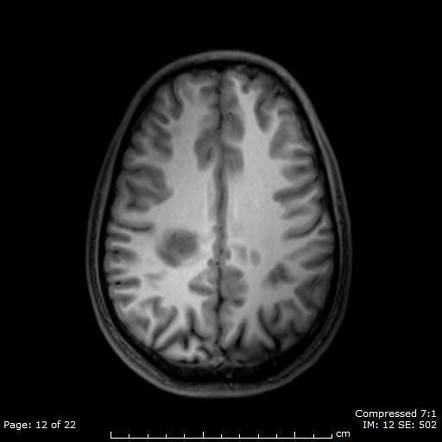 Tumefactive Multiple Sclerosis Radiology Reference Article Radiopaedia Org