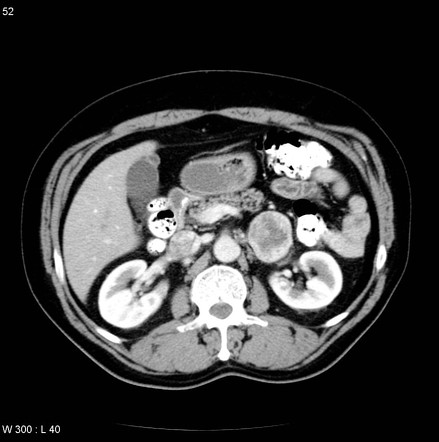 Adrenal gland tumors | Radiology Reference Article | Radiopaedia.org