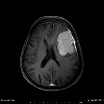 Meningioma | Radiology Case | Radiopaedia.org