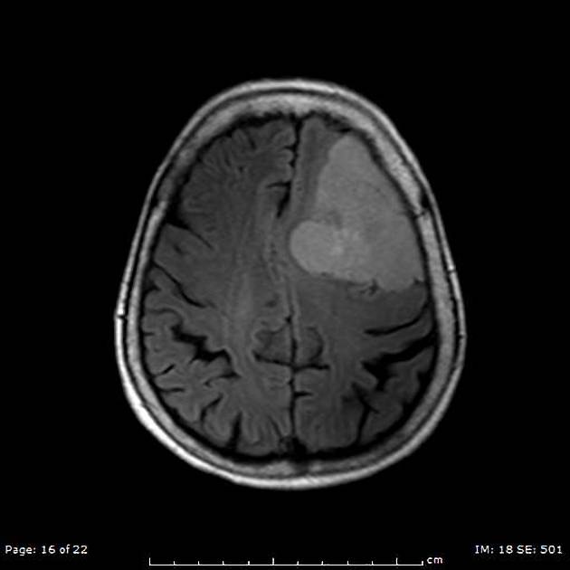 Meningioma | Radiology Reference Article | Radiopaedia.org