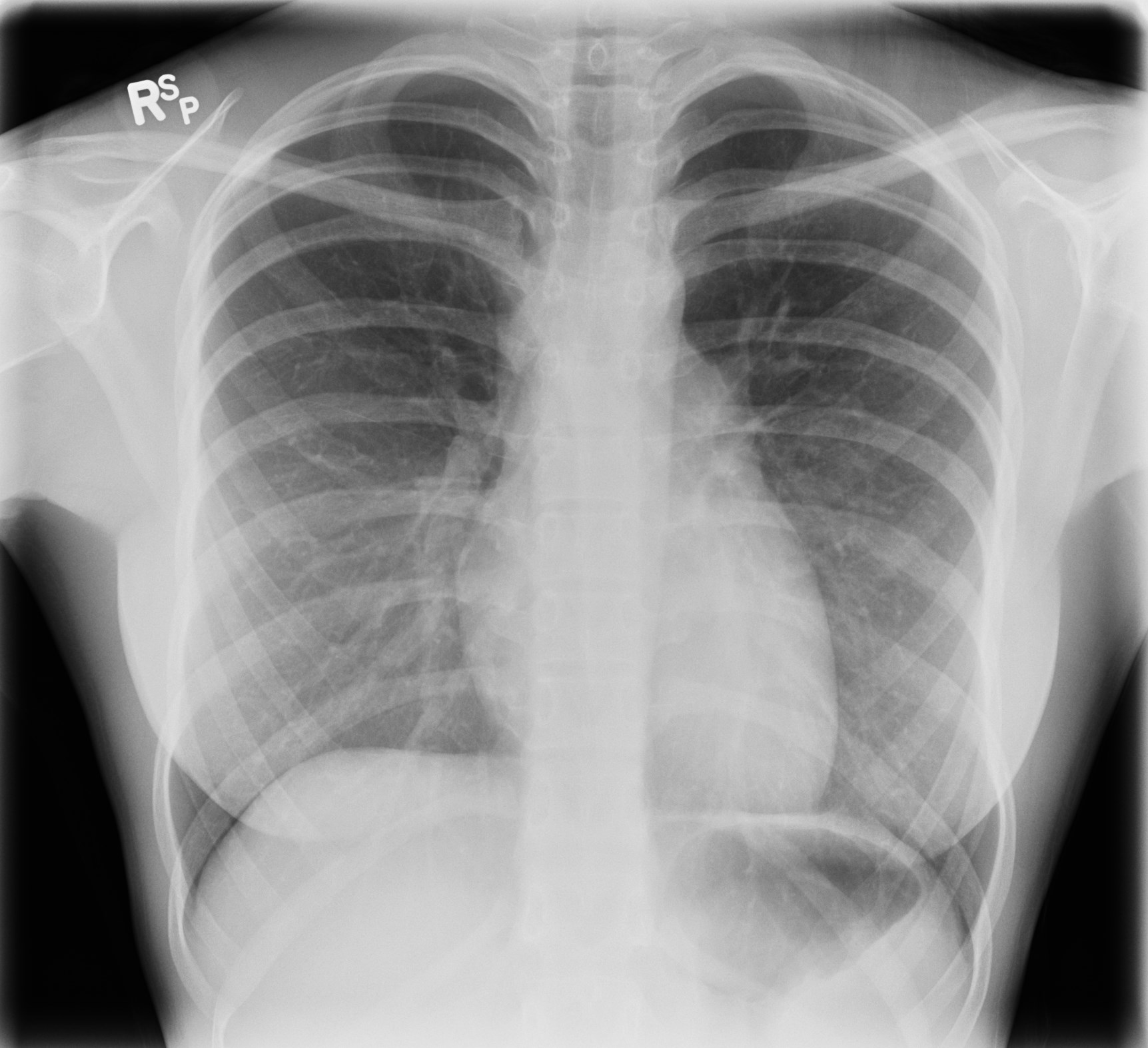 Thoracic schwannoma | Image | Radiopaedia.org