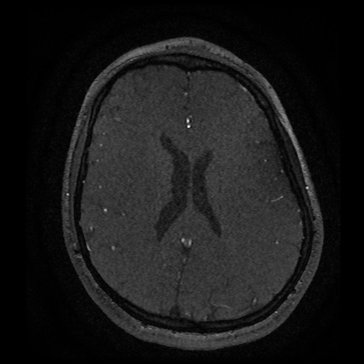 Subependymal Heterotopia Image