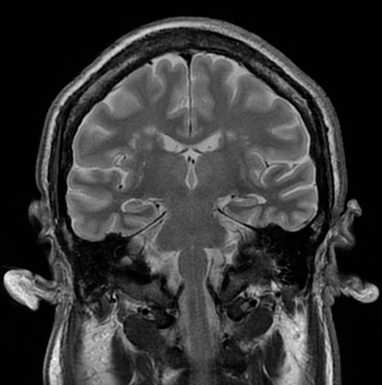 Susac syndrome | Image | Radiopaedia.org