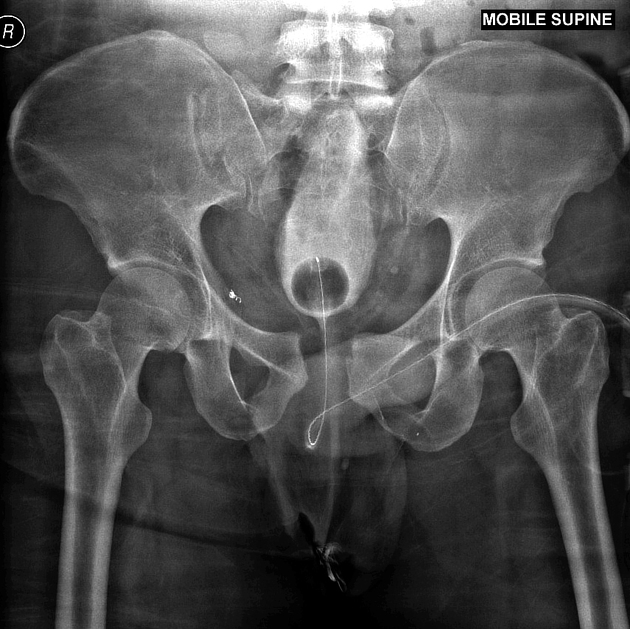 Pear-shaped bladder, Radiology Reference Article