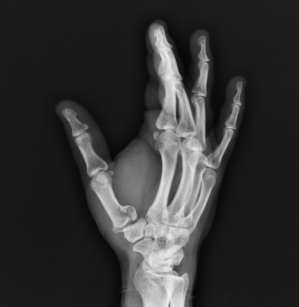 Rolando fracture | Image | Radiopaedia.org