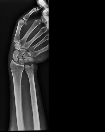 Scaphoid fracture | Image | Radiopaedia.org