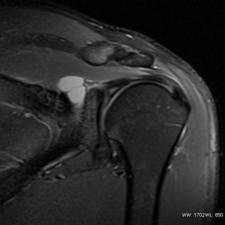 Chronic Superior Labral Anteroposterior Tear With Paralabral Cyst Radiology Case Radiopaedia Org