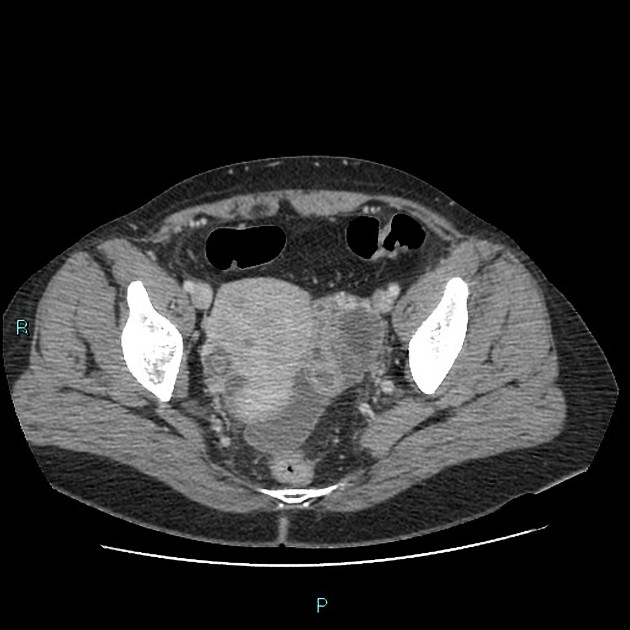 Bilateral tubo ovarian abscesses Radiology Case Radiopaedia