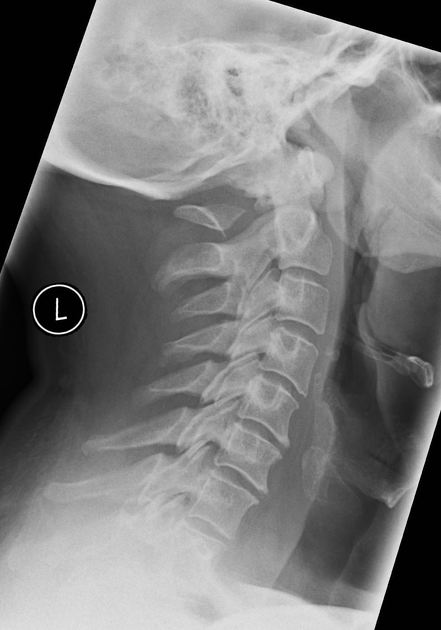 Congenital anomalies of the posterior atlas arch Radiology