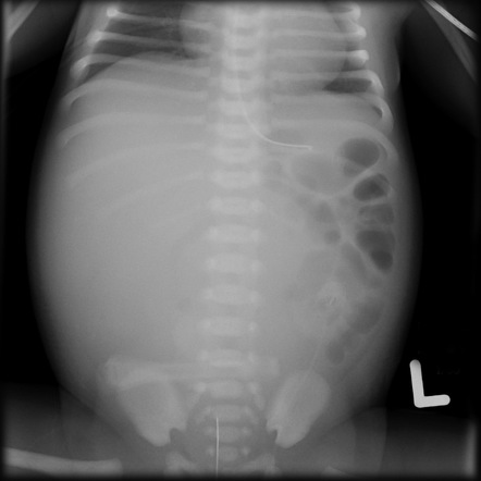 Midgut volvulus | Radiology Case | Radiopaedia.org