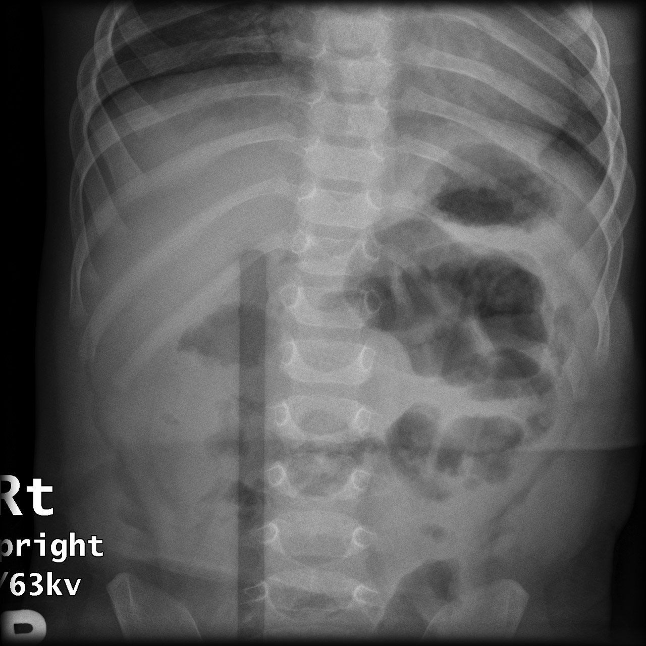 Intussusception Image